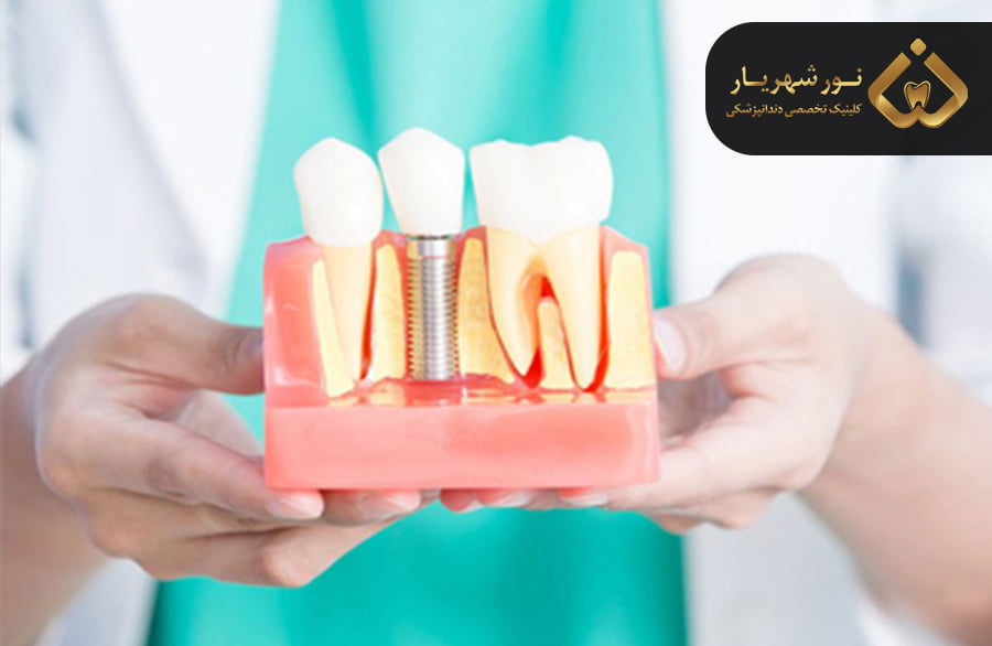 اجزای ایمپلنت