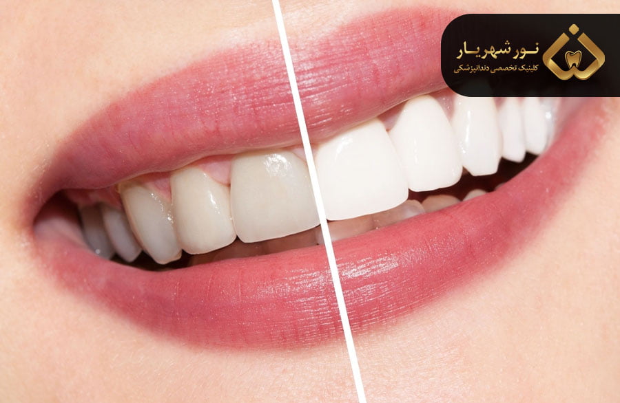 هزینه های دندانپزشکی زیبایی