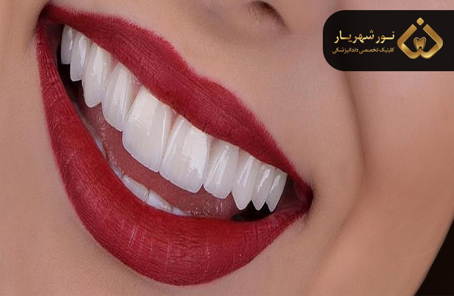 لمینت سرامیکی