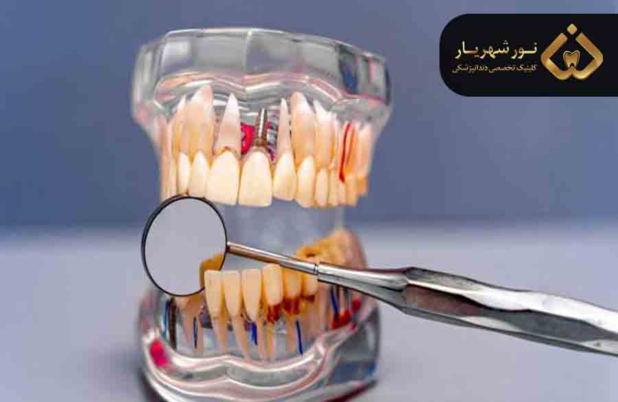 نکات ضروری در مورد کاشت دندان