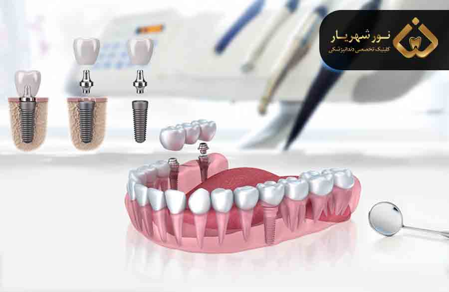 چگونه تورم بعد از ایمپلنت دندان را کنترل کنیم؟