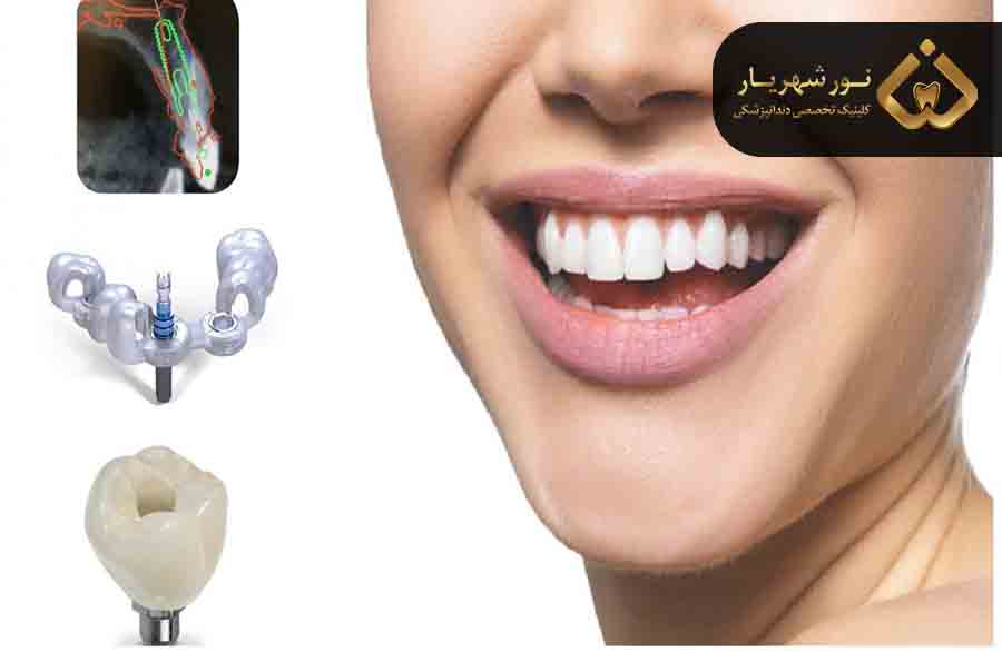 نکات مهم درباره ایمپلنت دندان
