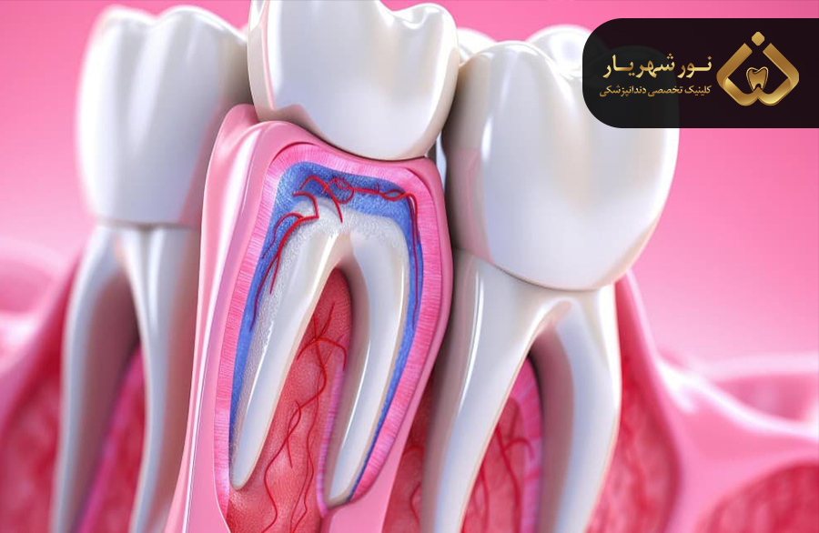 درمان ناقص ریشه دندان