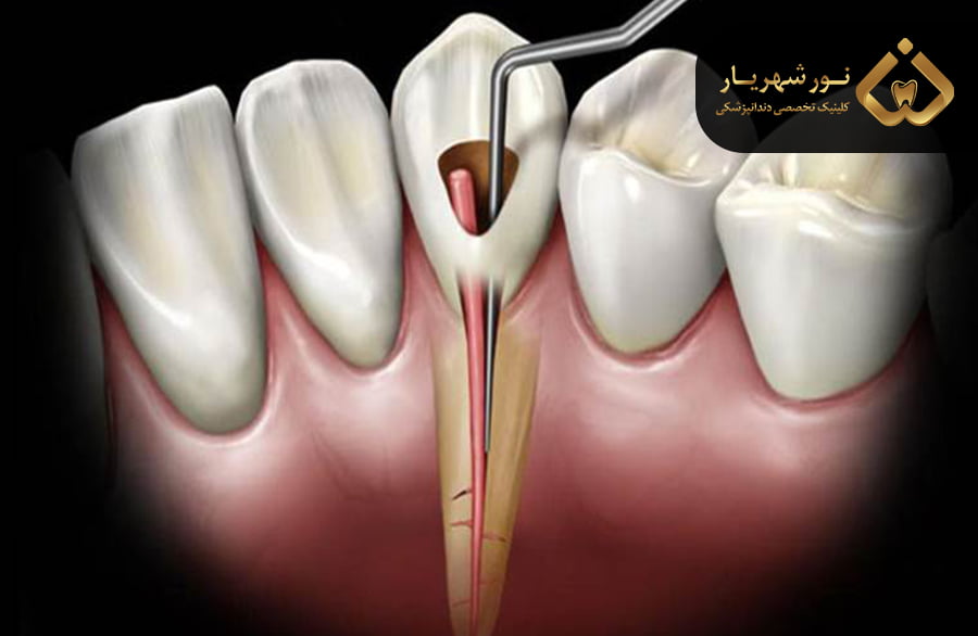 درمان ریشه دندان​​​​​​​ چیست؟