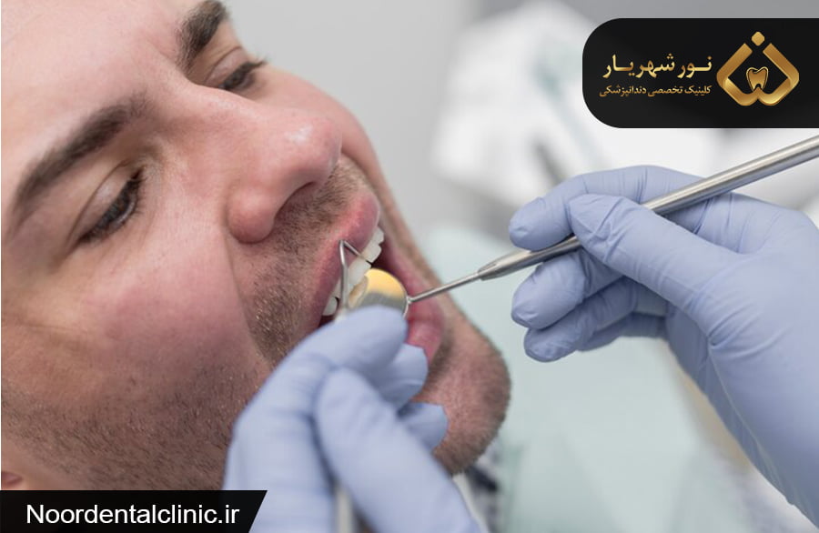 جرمگیری و بروساژ دندان در شهریار و اندیشه