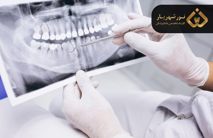 علائم و نشانههای پوسیدگی دندان