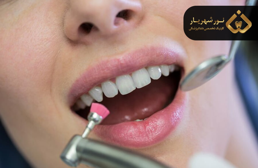 بهترین دکتر و کلینیک جرمگیری و بروساژ دندان