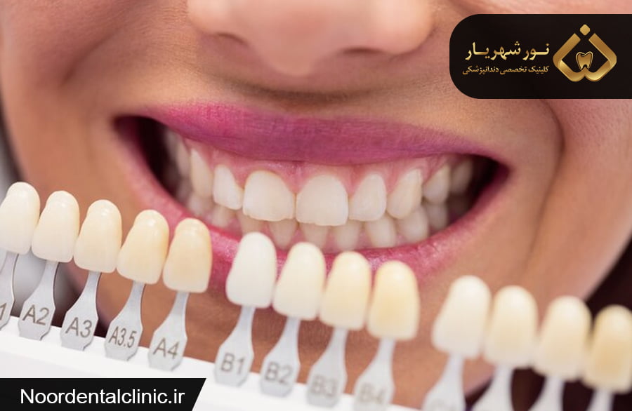 لمینت دندان در شهریار | انجام انواع لمینت دندان در شهریار