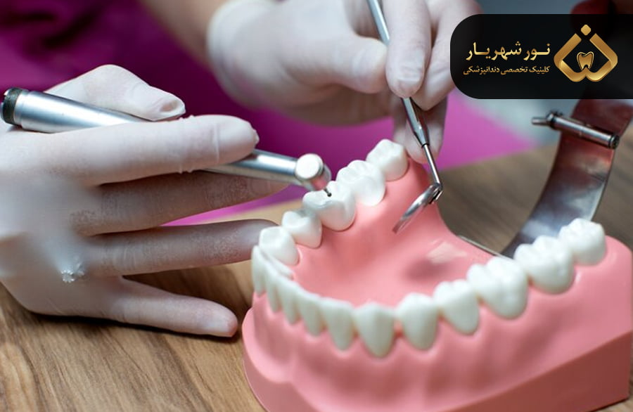 مراحل انجام پروتز دندان