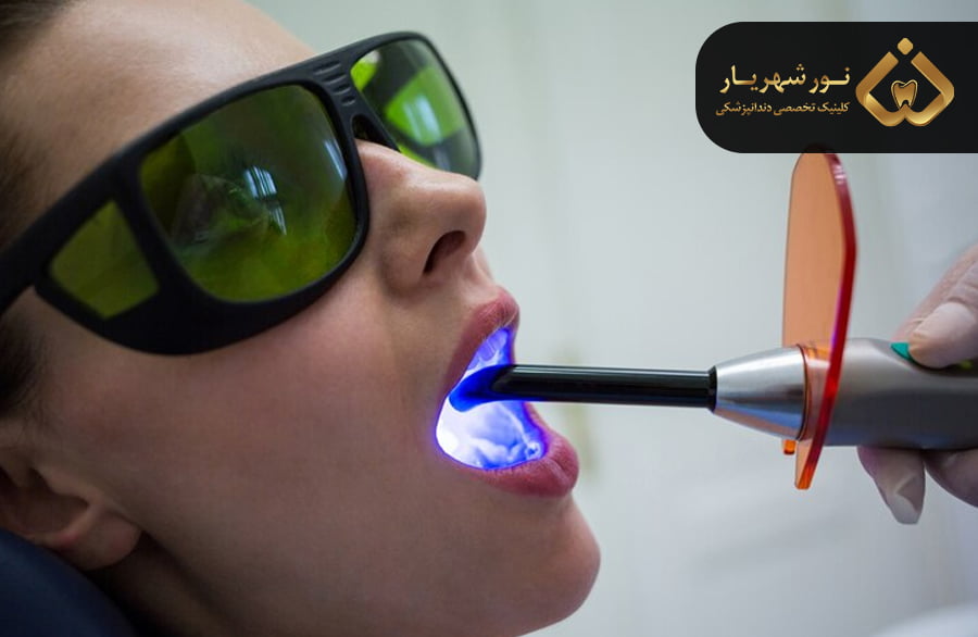 نکته نهایی در مورد بلیچینگ یا سفید کردن دندان