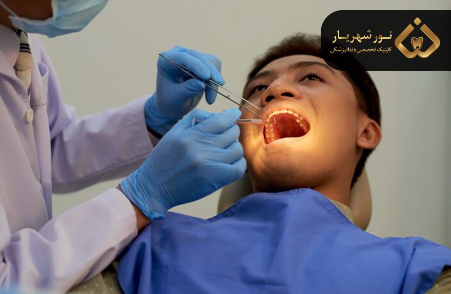 عصب کشی چند مرحله دارد؟