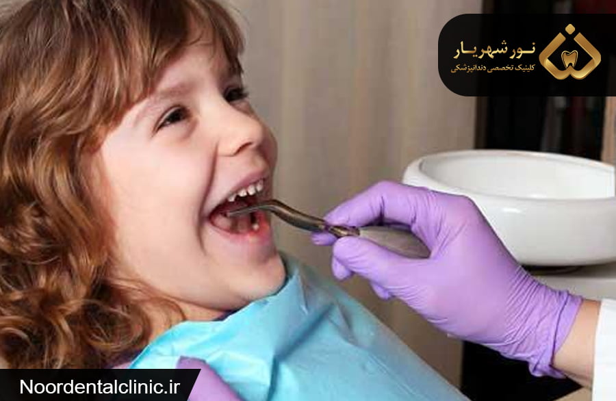فلوراید تراپی دندان کودکان در شهریار | فلوراید درمانی کودکان