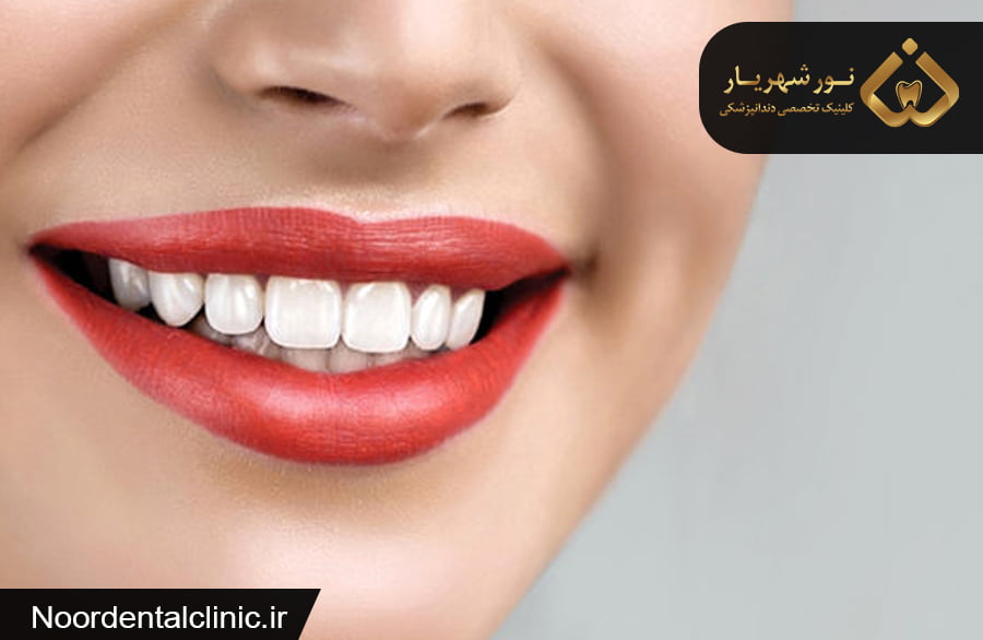 کامپوزیت برای چه کسانی مناسب است|کامپوزیت مناسب چه دندانیست