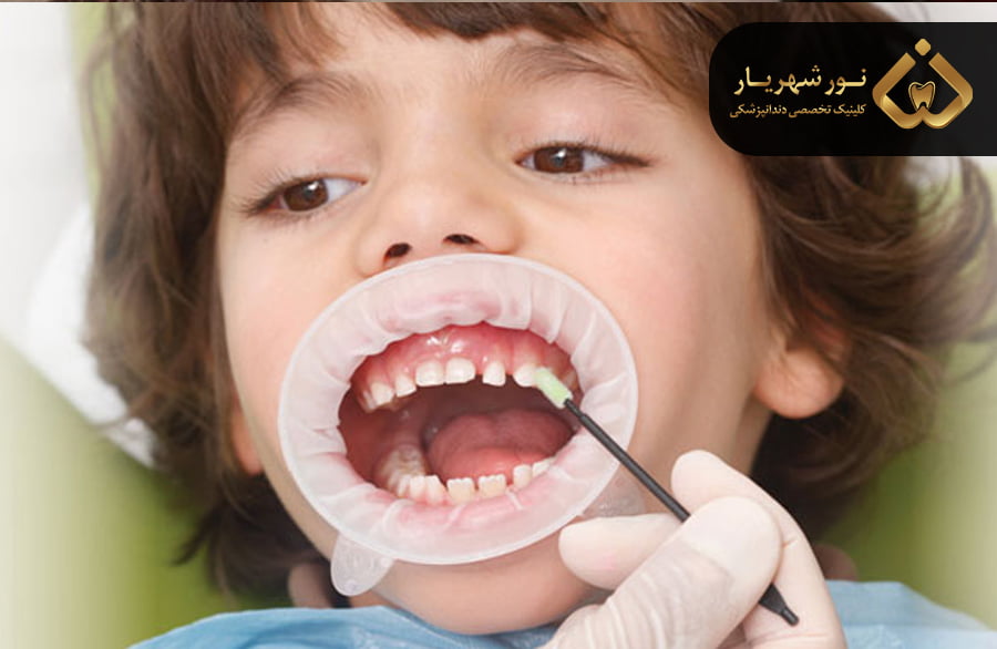 فلوراید تراپی چه اهمیتی دارد؟