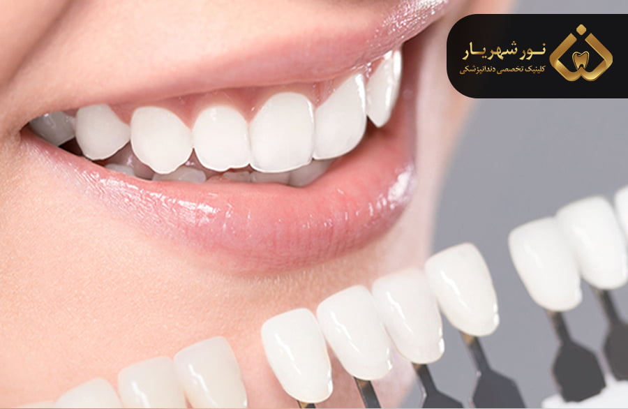 بهترین سن برای انجام کامپوزیت دندان چه سنی است؟