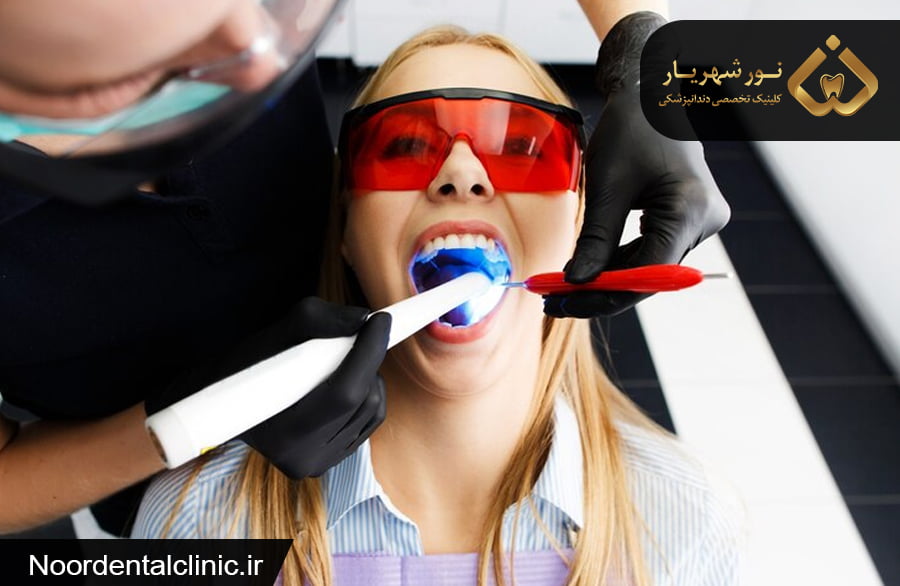 تفاوت لمینت و کامپوزیت و بلیچینگ|انجام لمینت، بلیچینگ شهریار