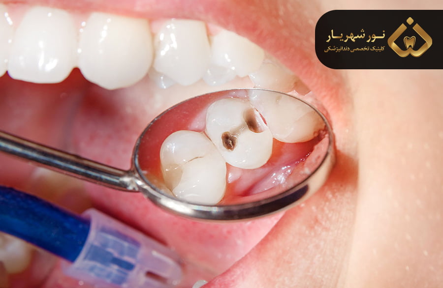 رفلاکس یا اسید معده چیست؟