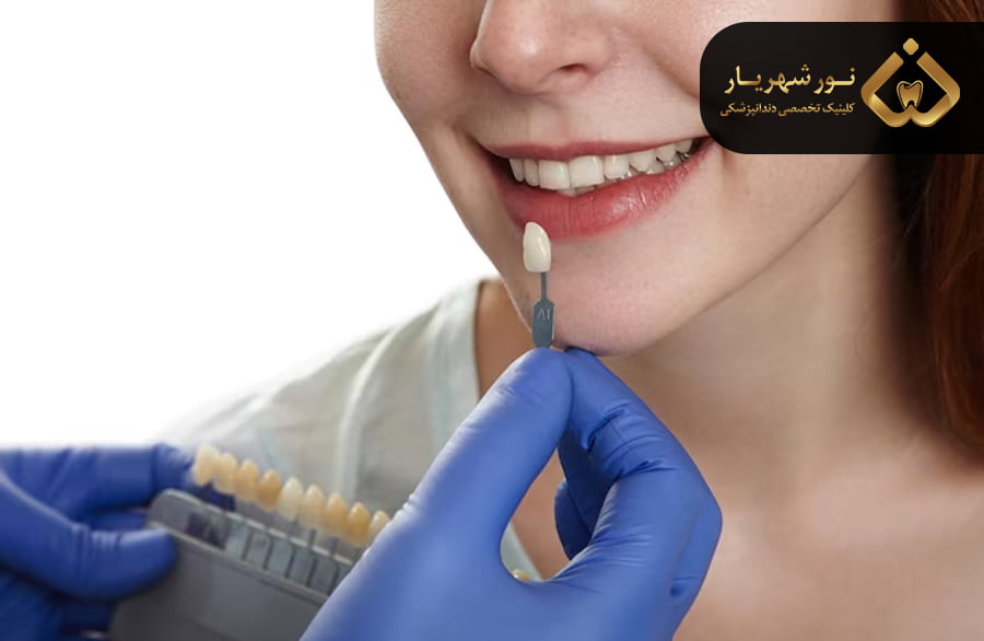 عوامل موثر در تغییر رنگ دندان و روش های سفید کننده