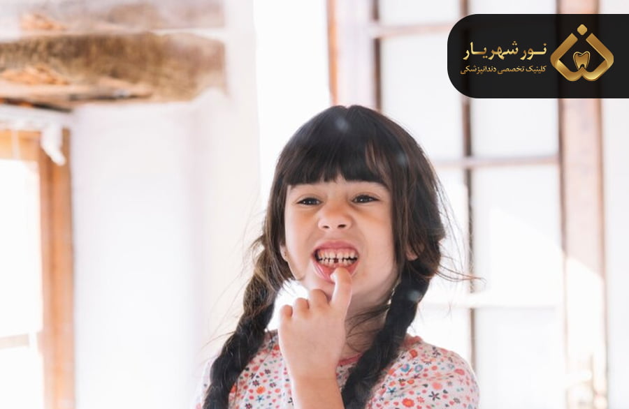 دلایل شکستگی دندان شیری در کودکان