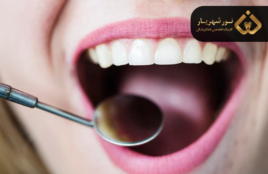 پیشگیری از زخم‌های آفتی دهان و ز بان