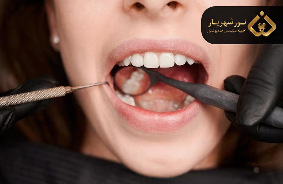 بلیچینگ دندان چیست؟