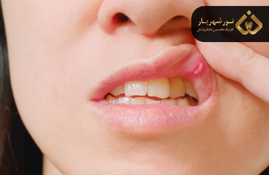 آفت دهان نشانه چیست؟