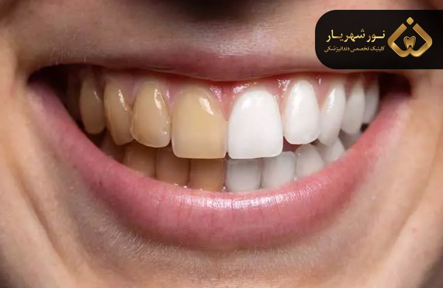 جرمگیری چیست و چه تاثیری بر سفید شدن دندان دارد؟