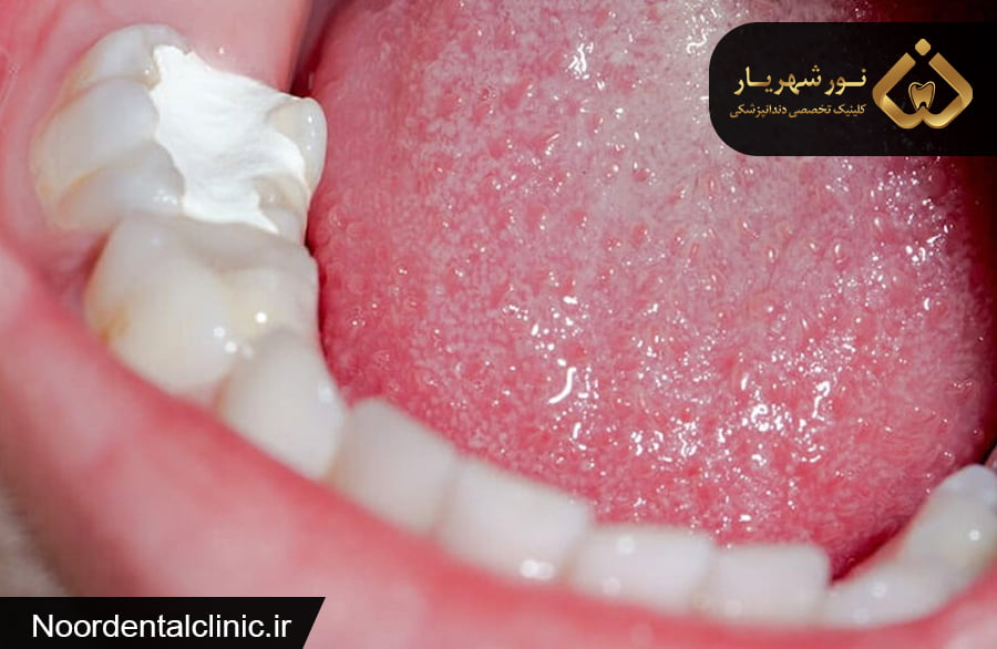 علت پانسمان دندان عصب کشی شده چیست؟