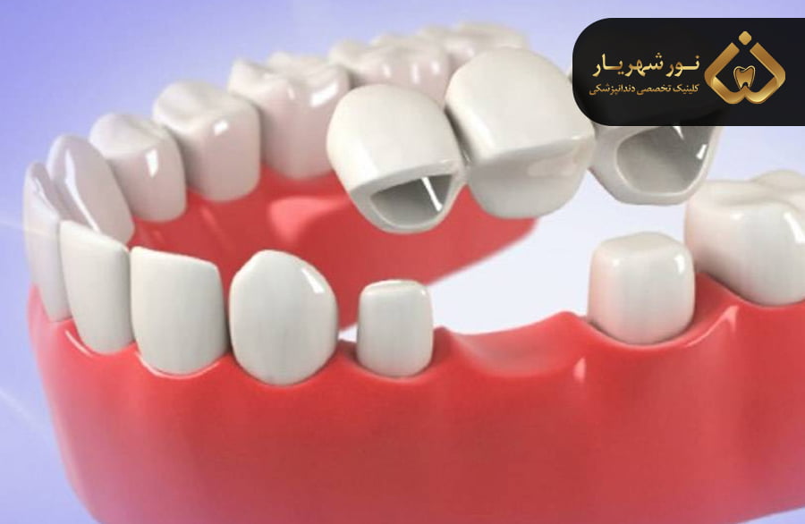 بریج دندان یا پل دندانی چیست؟