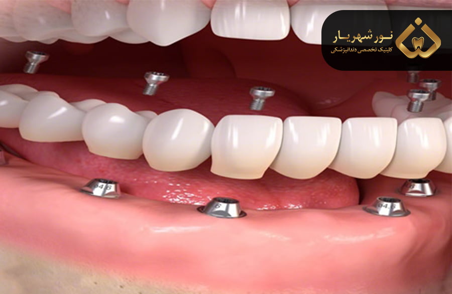 مزایای بریج دندان