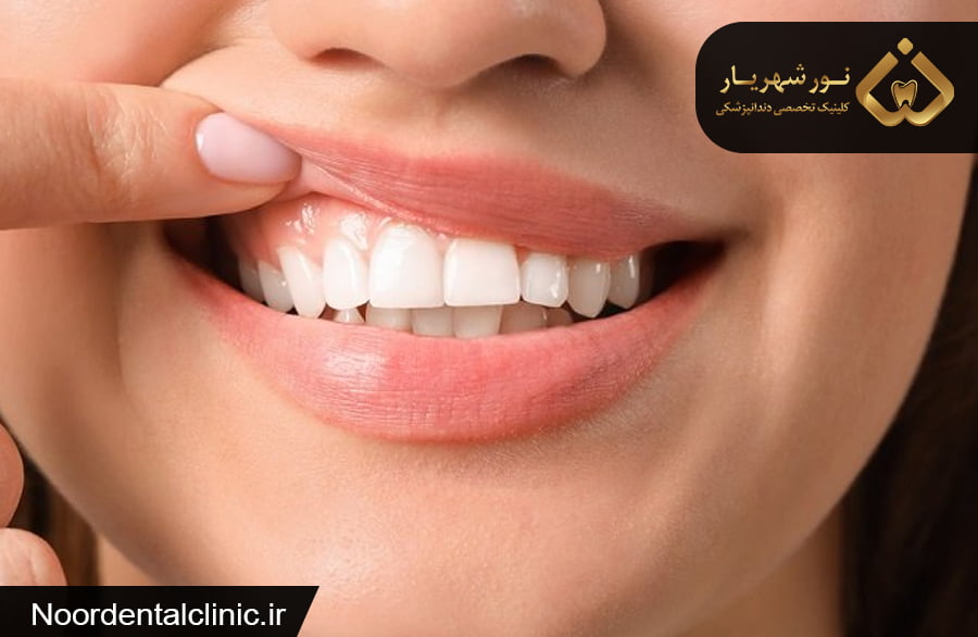 سیاهی لثه در کودکان و بزرگسالان |دلایل و راه درمان سیاهی لثه