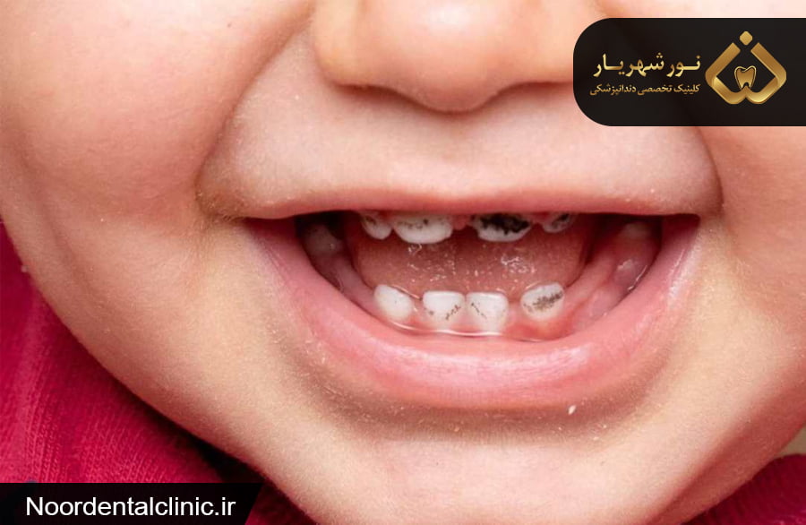 علت خرابی دندان کودکان با قطره آهن چیست وچه درمانی دارد؟