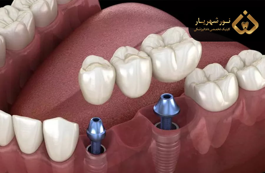 هزینه ایمپلنت و بریج، کدام بیشتر است؟