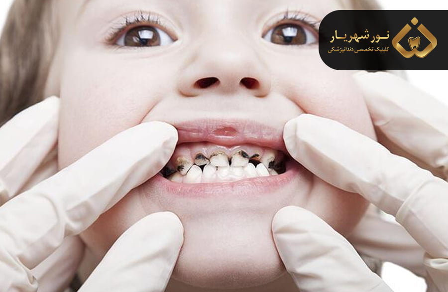 آیا مسواک زدن در جلوگیری از لک شدن دندان های کودک از قطرات آهن موثر است؟