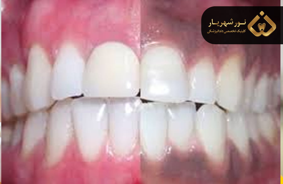 چگونه از سیاه شدن لثه‌ها پیشگیری کنیم؟