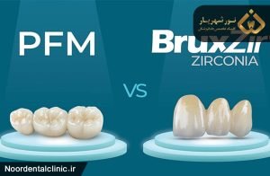 تفاوت روکش زیرکونیا و روکش PFM اف ام در چیست؟