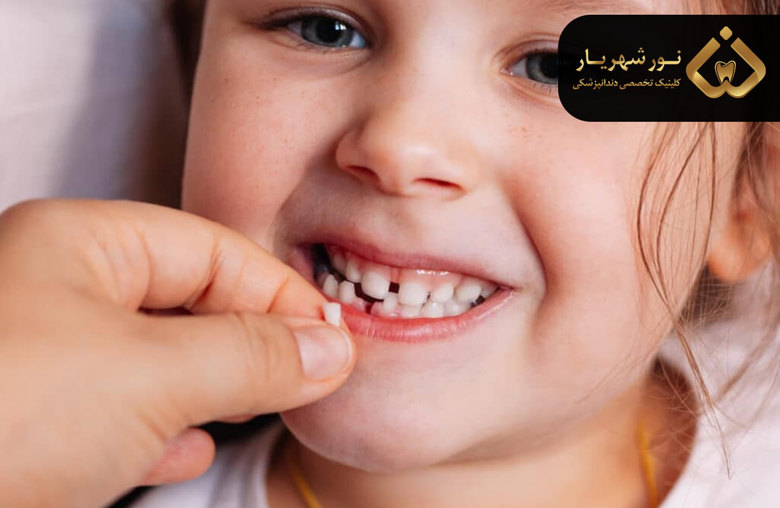مراقبت های بعد از کشیدن دندان شیری کودک