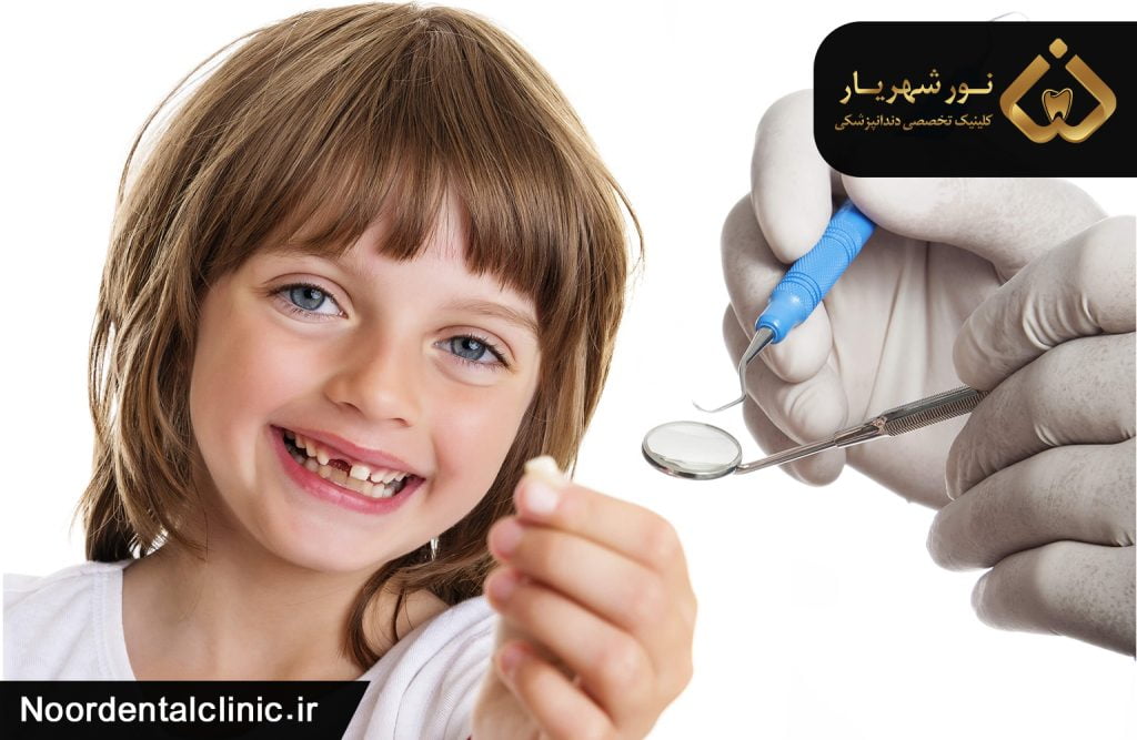 کشیدن دندان شیری کودکان در چه شرایطی لازم است؟