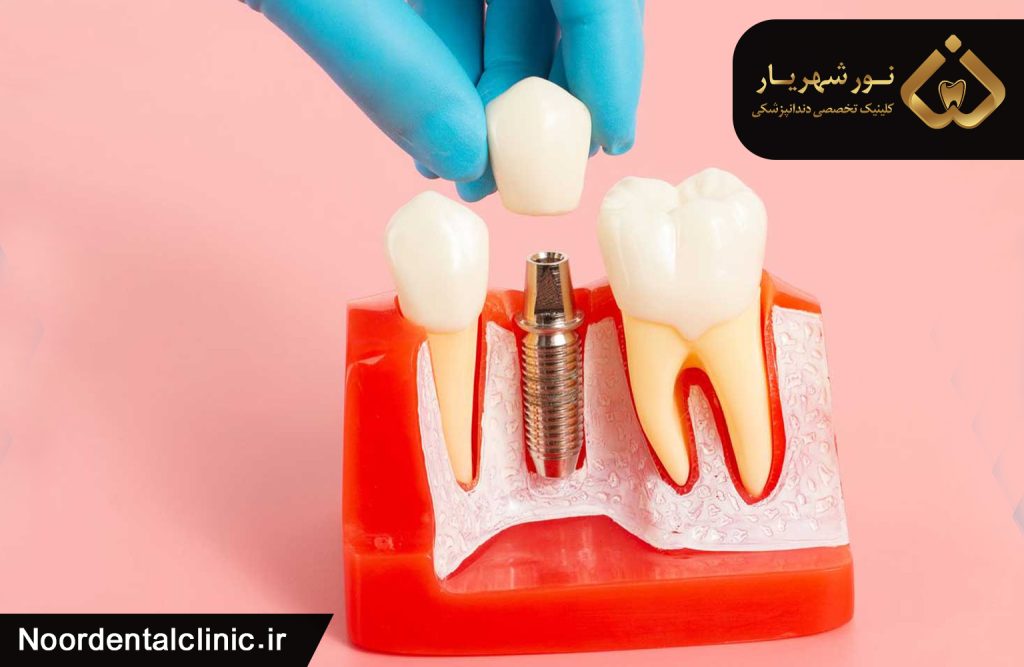 آیا کاشت ایمپلنت با وجود پوکی استخوان امکان پذیر است؟