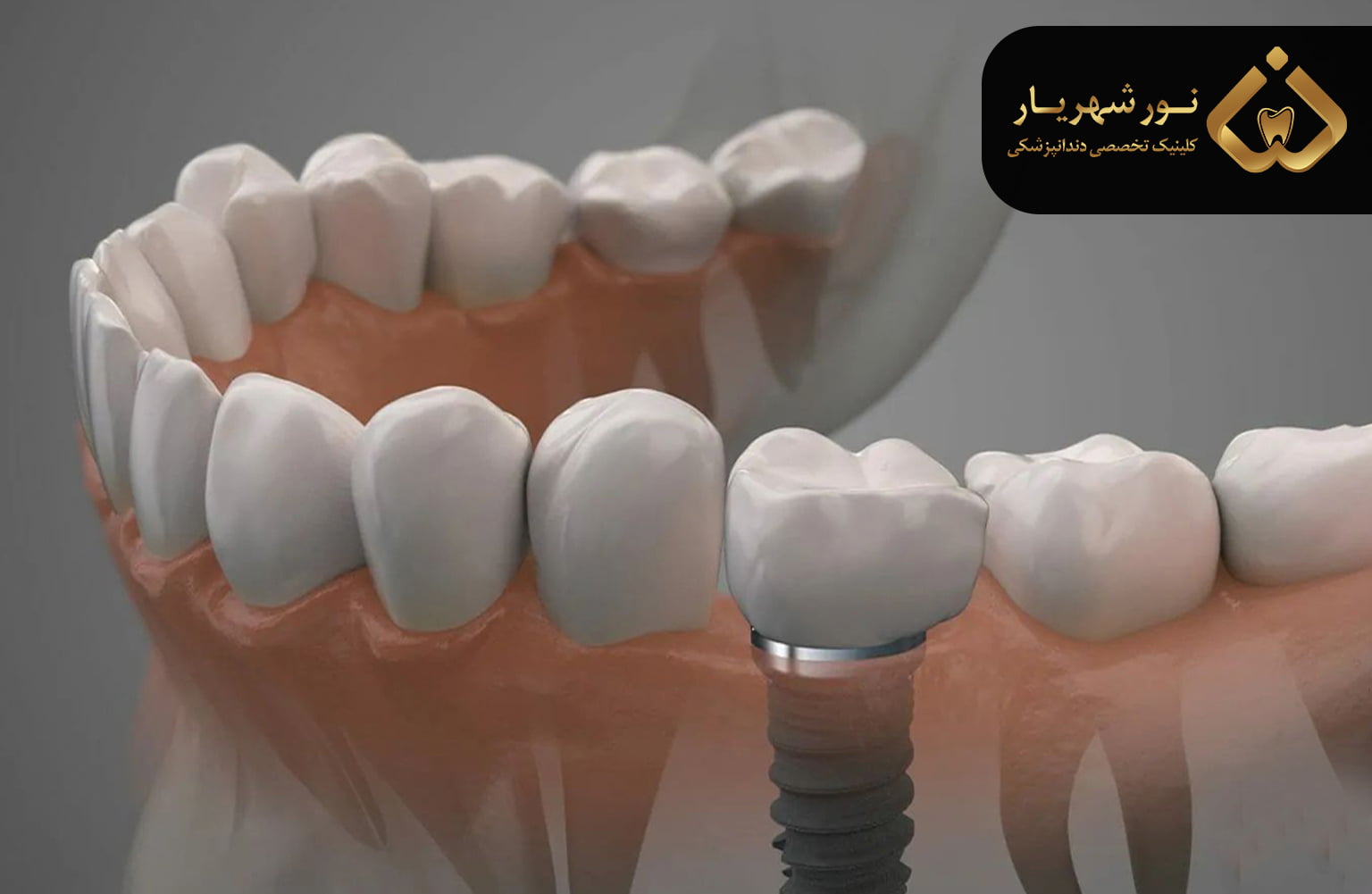 پیشگیری از پوکی استخوان فک و تحلیل رفتن آن چگونه است؟