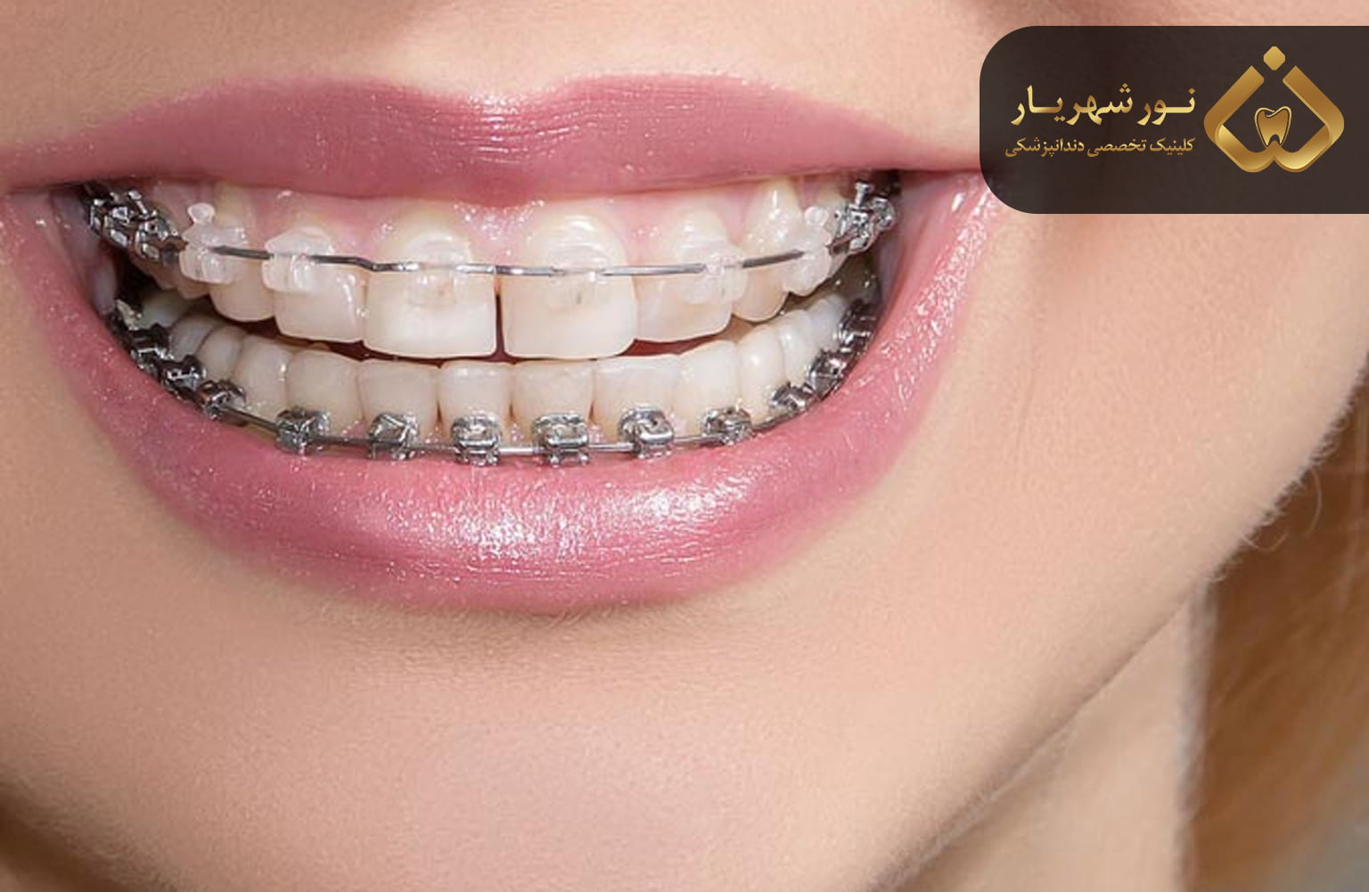 مزایای ارتودنسی دندان ایمپلنت شده
