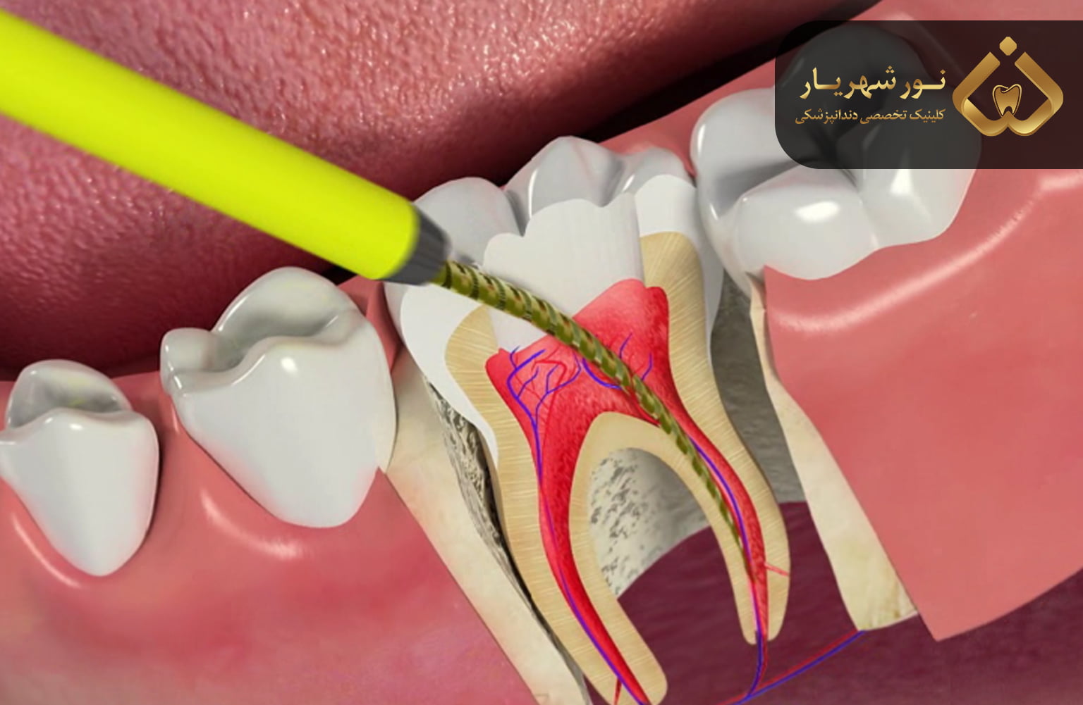 آیا دندانهای عصب کشی و لمینت شده نیاز به مراقبت ویژهای دارند؟