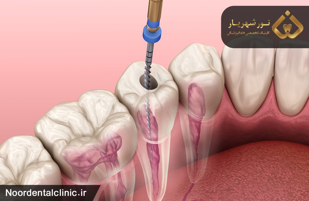 دندان لمینت شده را چگونه می توان عصب کشی کرد؟