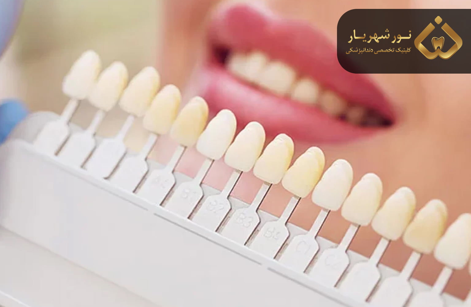 لمینت دندان چیست؟