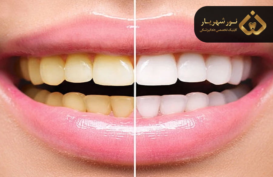 چطور باید قیمت بلیچینگ دندان را کاهش داد؟