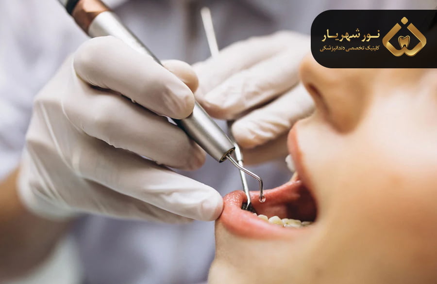 پوسیدگی چه زمانی ظاهر می شود؟