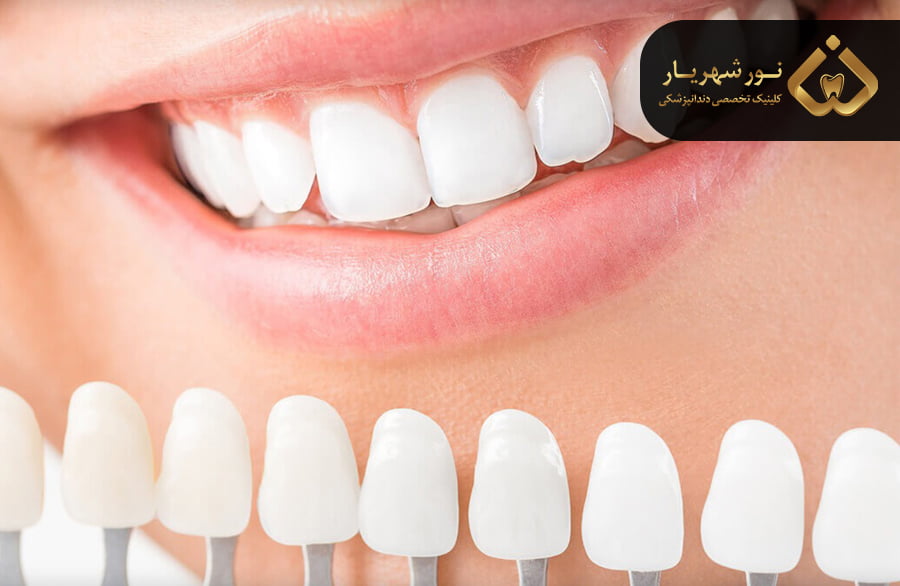 تفاوت قیمت لمینت با کامپوزیت