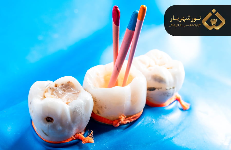 سایر عوامل موثر بر قیمت عصب کشی دندان