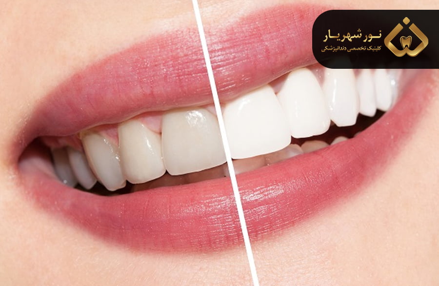 لمینت دندان برای چه کسانی مناسب است؟