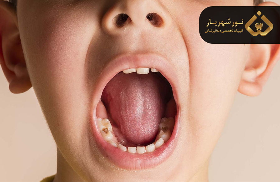 روش های پیشگیری از پوسیدگی دندان دائمی کودکان